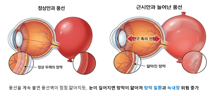 근시는 안축장이 길어지면서 빛을 망막보다 앞에 모을 때 생긴다.이때 망막이 얇아져 망막질환·녹내장 등 합병증 위험이 함께 올라간다.대한안과학회 눈의 날 팩트시트